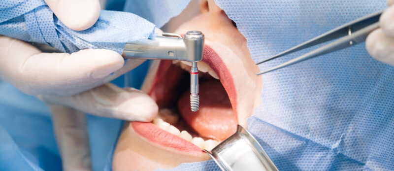 Dental Implant